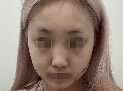줄기세포가 풍부한 SVF 파워 V - 1 - 더라인성형외과