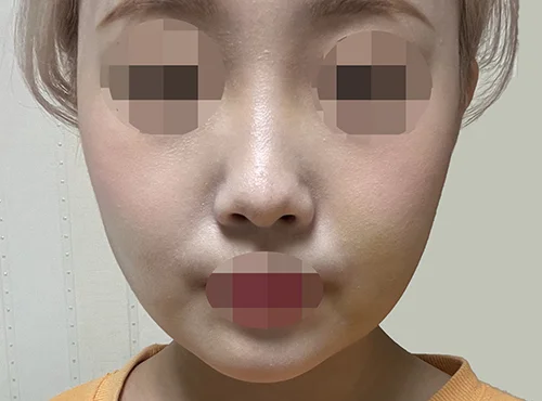줄기세포가 풍부한 SVF 파워 V - 3 - 더라인성형외과