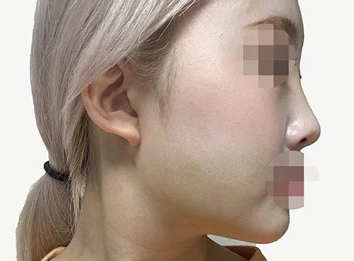 줄기세포가 풍부한 SVF 파워 V - 4 - 더라인성형외과