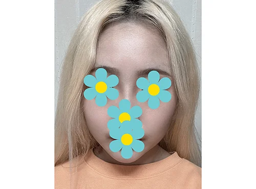 줄기세포가 풍부한 SVF 파워 V - 5 - 더라인성형외과