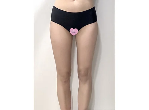 줄기세포가 풍부한 SVF 승마 지방흡입+ 골반 지방이식 - 5 - 더라인성형외과