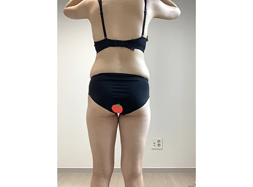 줄기세포가 풍부한 SVF 허골승 (허벅지지방흡입, 승마살지방흡입, 복부 지방흡입, 골반+엉덩이지방이식) - 2 - 더라인성형외과
