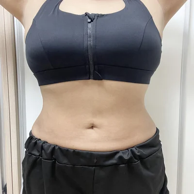 줄기세포가 풍부한 SVF 복부 지방흡입 (복부+러브핸들) - 5 - 더라인성형외과