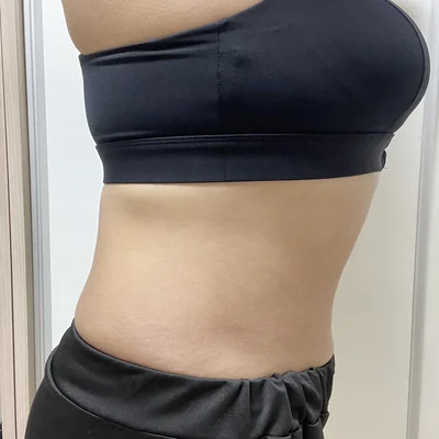 줄기세포가 풍부한 SVF 복부 지방흡입 (복부+러브핸들) - 6 - 더라인성형외과