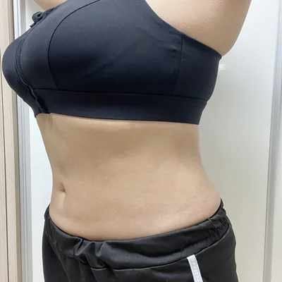 줄기세포가 풍부한 SVF 복부 지방흡입 (복부+러브핸들) - 7 - 더라인성형외과