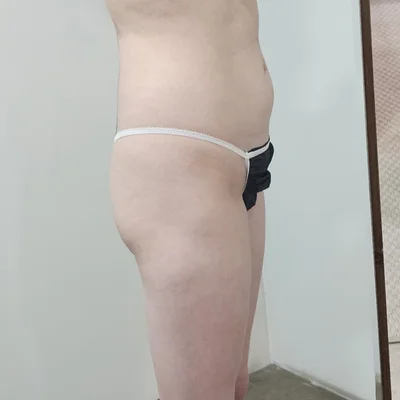 줄기세포가 풍부한 SVF 허골승 (허벅지지방흡입, 승마살지방흡입, 복부 지방흡입, 골반+엉덩이지방이식) - 2 - 더라인성형외과