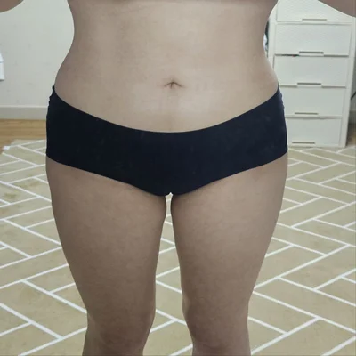 줄기세포가 풍부한 SVF 허골승 (허벅지지방흡입, 승마살지방흡입, 복부 지방흡입, 골반+엉덩이지방이식) - 4 - 더라인성형외과