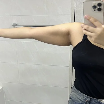 줄기세포가 풍부한 SVF 팔 지방흡입 - 2 - 더라인성형외과
