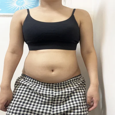 줄기세포가 풍부한 SVF 복부 지방흡입 - 2 - 더라인성형외과
