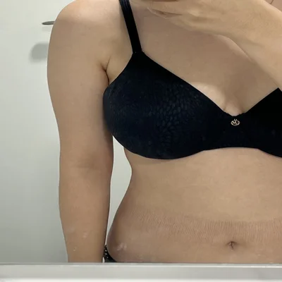 줄기세포가 풍부한 SVF 팔+ 복부+ 코르셋 지방흡입 - 2 - 더라인성형외과