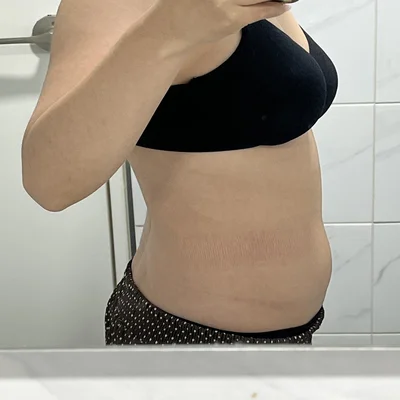 줄기세포가 풍부한 SVF 팔+ 복부+ 코르셋 지방흡입 - 3 - 더라인성형외과