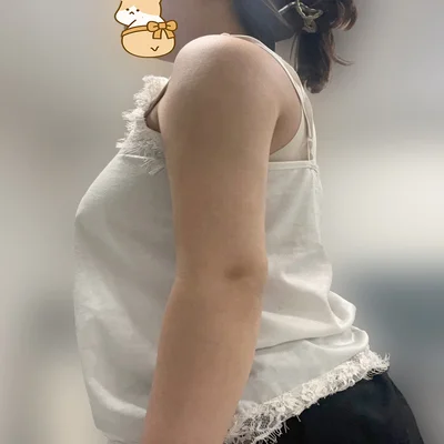 줄기세포가 풍부한 SVF 팔 지방흡입 - 6 - 더라인성형외과