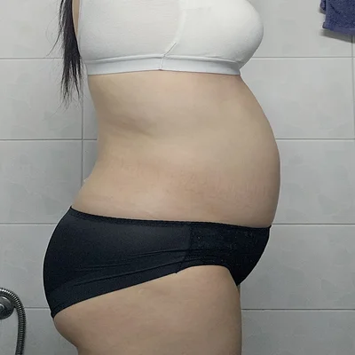 줄기세포가 풍부한 SVF 복부 지방흡입 - 1 - 더라인성형외과