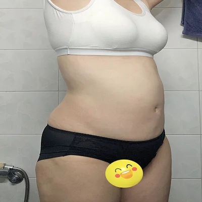 줄기세포가 풍부한 SVF 복부 지방흡입 - 2 - 더라인성형외과