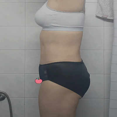 줄기세포가 풍부한 SVF 복부 지방흡입 - 6 - 더라인성형외과