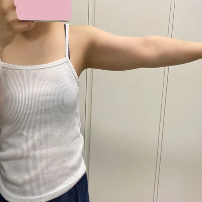 줄기세포가 풍부한 SVF 팔+부유방 지방흡입 - 3 - 더라인성형외과
