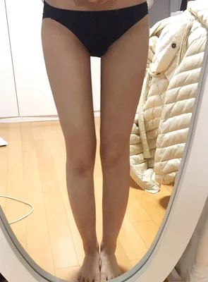 줄기세포가 풍부한 SVF 허벅지 지방흡입 - 5 - 더라인성형외과