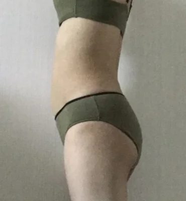 줄기세포가 풍부한 SVF 허골승 (허벅지지방흡입, 승마살지방흡입, 복부 지방흡입, 골반+엉덩이지방이식) - 4 - 더라인성형외과