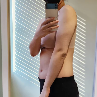 줄기세포가 풍부한 SVF 상체 지방흡입 (팔+팔주변+복부+러브핸들) - 2 - 더라인성형외과