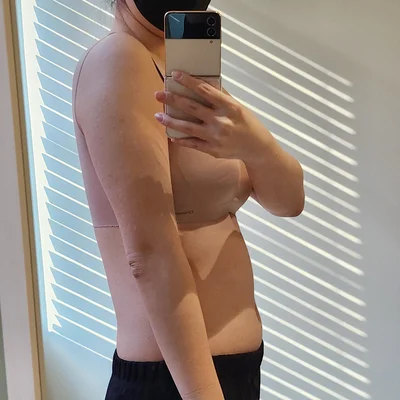 줄기세포가 풍부한 SVF 상체 지방흡입 (팔+팔주변+복부+러브핸들) - 3 - 더라인성형외과
