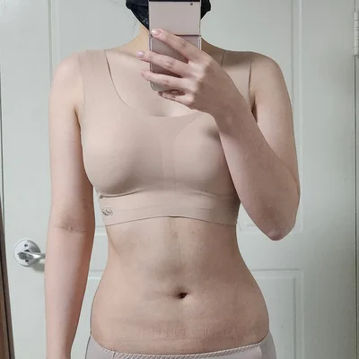 줄기세포가 풍부한 SVF 상체 지방흡입 (팔+팔주변+복부+러브핸들) - 4 - 더라인성형외과