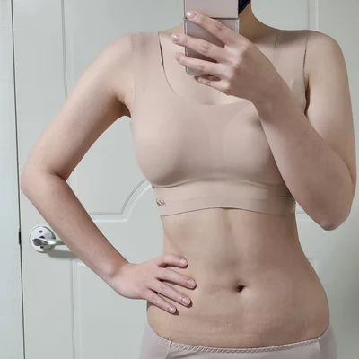 줄기세포가 풍부한 SVF 상체 지방흡입 (팔+팔주변+복부+러브핸들) - 5 - 더라인성형외과