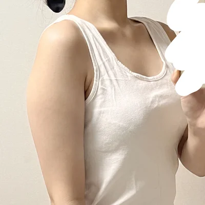 줄기세포가 풍부한 SVF 팔 지방흡입 - 1 - 더라인성형외과