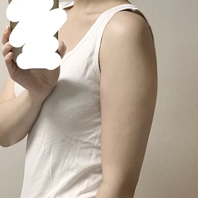 줄기세포가 풍부한 SVF 팔 지방흡입 - 3 - 더라인성형외과