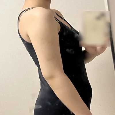 줄기세포가 풍부한 SVF 팔 지방흡입 - 4 - 더라인성형외과