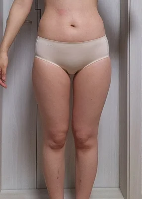 줄기세포가 풍부한 SVF 허벅지 지방흡입 - 1 - 더라인성형외과