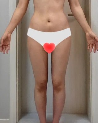 줄기세포가 풍부한 SVF 허벅지 지방흡입 - 4 - 더라인성형외과