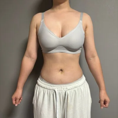 줄기세포가 풍부한 SVF 복부+코르셋 지방흡입 - 5 - 더라인성형외과