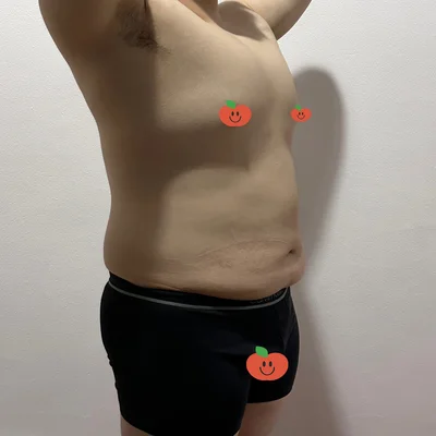 줄기세포가 풍부한 SVF 남자 복부 지방흡입 (복부+코르셋+여유증) - 2 - 더라인성형외과