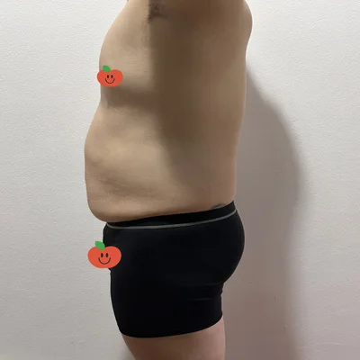 줄기세포가 풍부한 SVF 남자 복부 지방흡입 (복부+코르셋+여유증) - 3 - 더라인성형외과