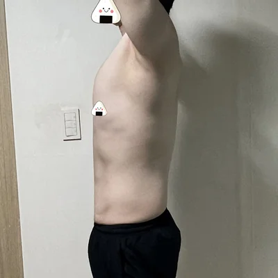 줄기세포가 풍부한 SVF 남자 복부 지방흡입 (복부+코르셋+여유증) - 6 - 더라인성형외과