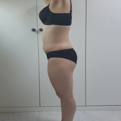 줄기세포가 풍부한 SVF 복부+러브핸들 지방흡입 - 1 - 더라인성형외과