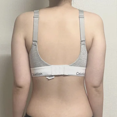 줄기세포가 풍부한 SVF 팔+부유방+뿌리 지방흡입 - 2 - 더라인성형외과