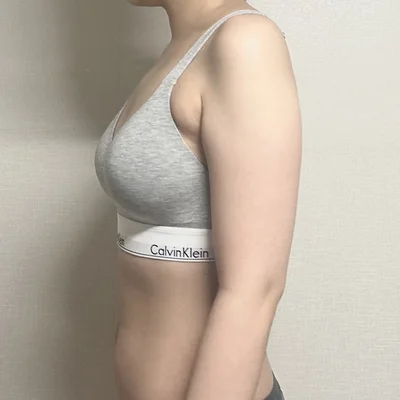 줄기세포가 풍부한 SVF 팔+부유방+뿌리 지방흡입 - 3 - 더라인성형외과