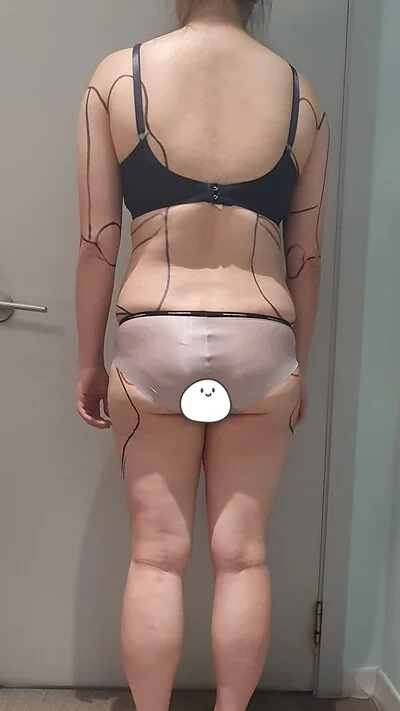줄기세포가 풍부한 SVF 복부+코르셋 지방흡입 - 3 - 더라인성형외과