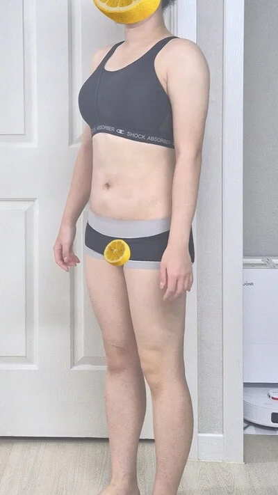 줄기세포가 풍부한 SVF 복부+코르셋 지방흡입 - 4 - 더라인성형외과