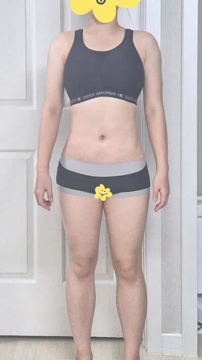 줄기세포가 풍부한 SVF 복부+코르셋 지방흡입 - 5 - 더라인성형외과