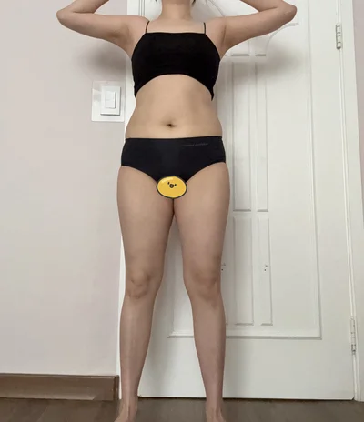 줄기세포가 풍부한 SVF 복부+러브핸들+허벅지 내측 지방흡입 - 1 - 더라인성형외과