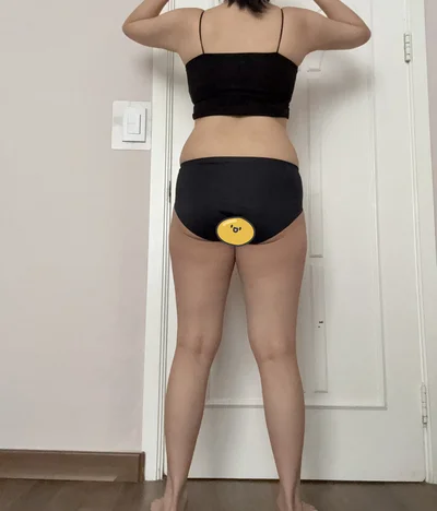 줄기세포가 풍부한 SVF 복부+러브핸들+허벅지 내측 지방흡입 - 2 - 더라인성형외과
