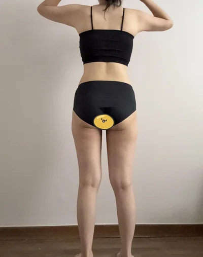 줄기세포가 풍부한 SVF 복부+러브핸들+허벅지 내측 지방흡입 - 4 - 더라인성형외과
