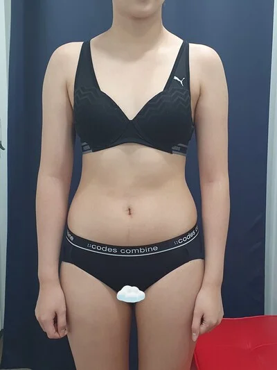 줄기세포가 풍부한 SVF 복부+러브핸들 지방흡입 - 1 - 더라인성형외과