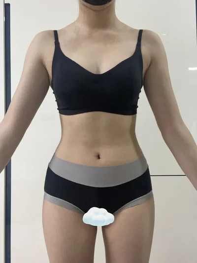 줄기세포가 풍부한 SVF 복부+러브핸들 지방흡입 - 4 - 더라인성형외과