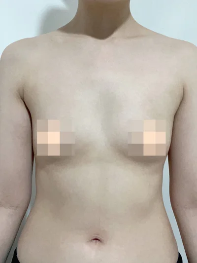 줄기세포가 풍부한 SVF 가슴 지방이식 - 3 - 더라인성형외과
