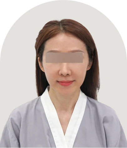 SVF 딥플레인 안면거상 수술 후 1개월 정면 - 더라인성형외과