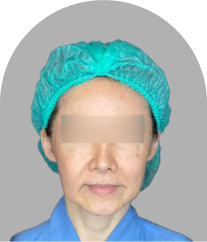 SVF 딥플레인 안면거상 수술 전 정면 - 더라인성형외과
