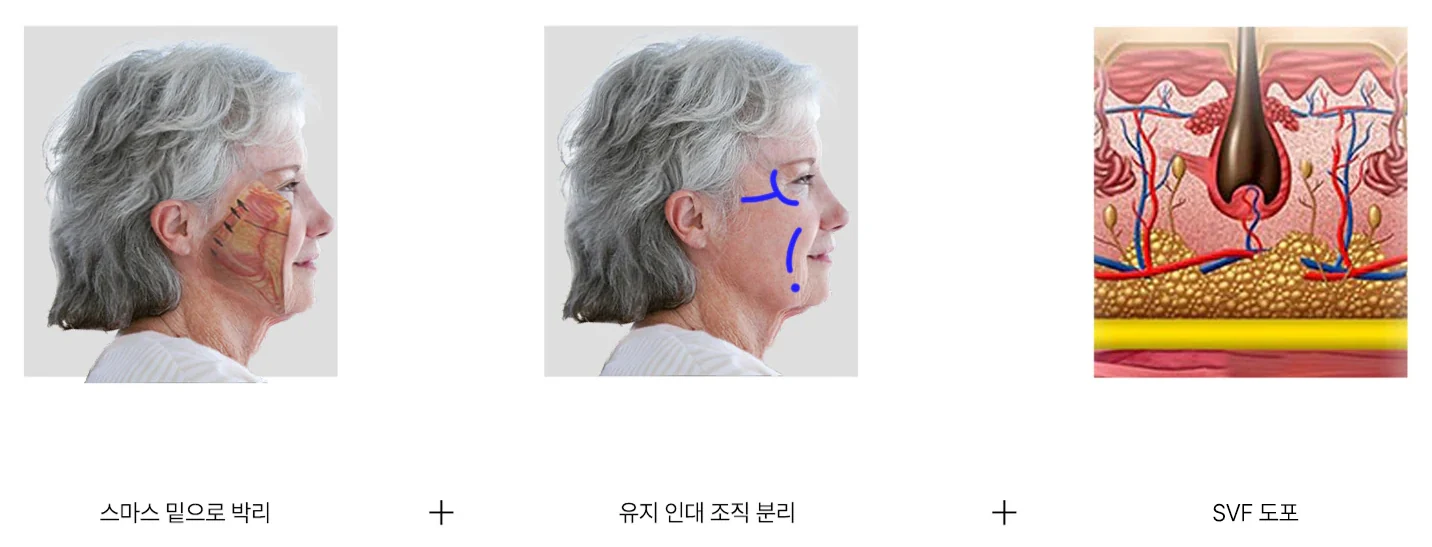 SVF 딥플레인 안면거상 원리 - 스마스 밑 박리, 유지인대 조직 분리, SVF 도포 - 더라인성형외과
